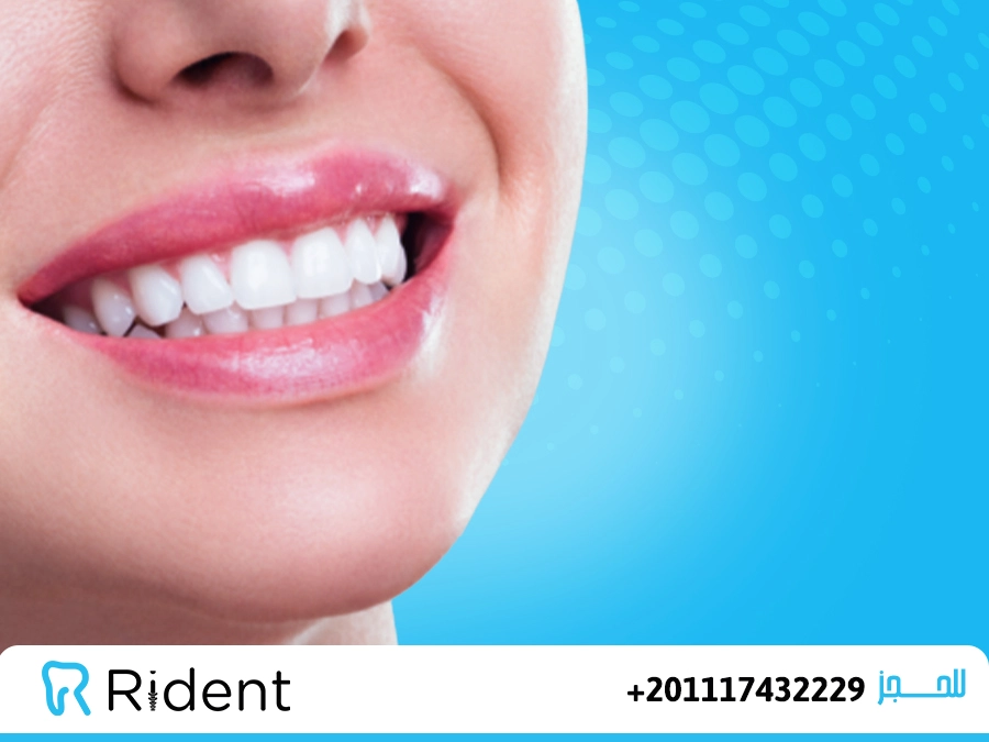 الفروق بين الفينير و اللومينير