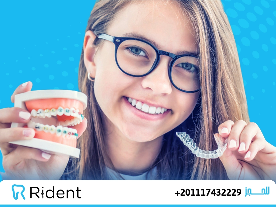 الفرق بين مثبت التقويم الشفاف والحديد، أيهما تختار بعد إزالة التقويم؟ 4 الفرق بين مثبت التقويم الشفاف والحديد