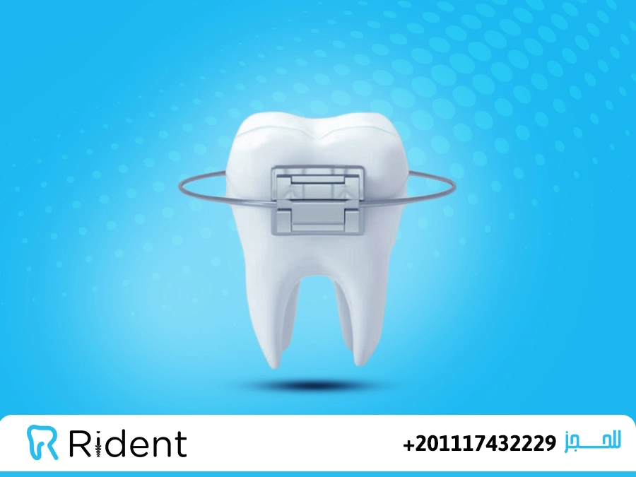 الفرق بين مثبت التقويم الشفاف والحديد، أيهما تختار بعد إزالة التقويم؟ 1 تقويم الاسنان الحديد