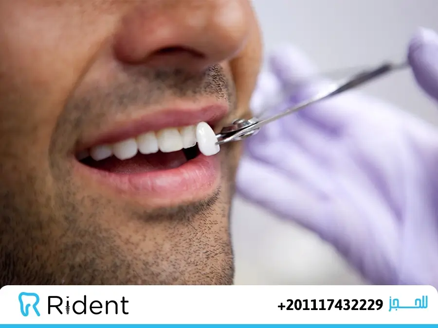 الفينير للأسنان و11 سؤال وجواب متعلق به