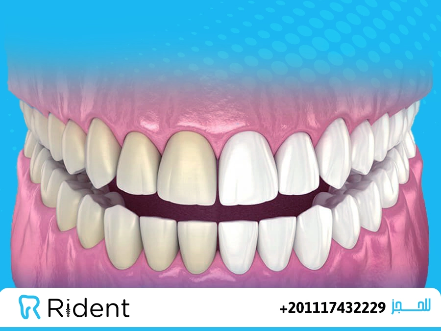 انواع تبييض الاسنان