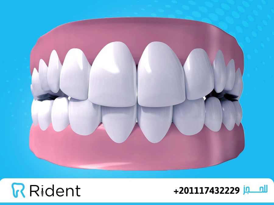 انواع تبييض الاسنان 1 انواع تبييض الاسنان
