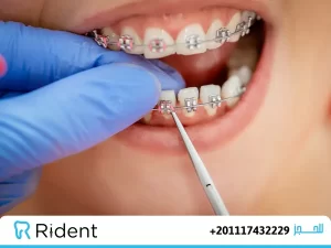 انواع تقويم الاسنان