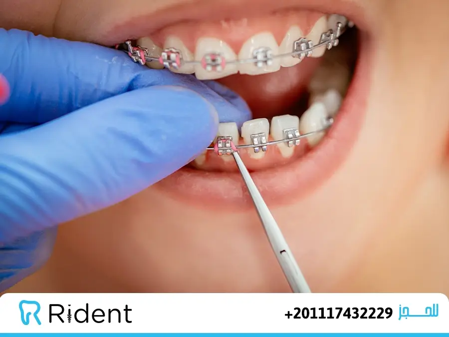 انواع تقويم الاسنان