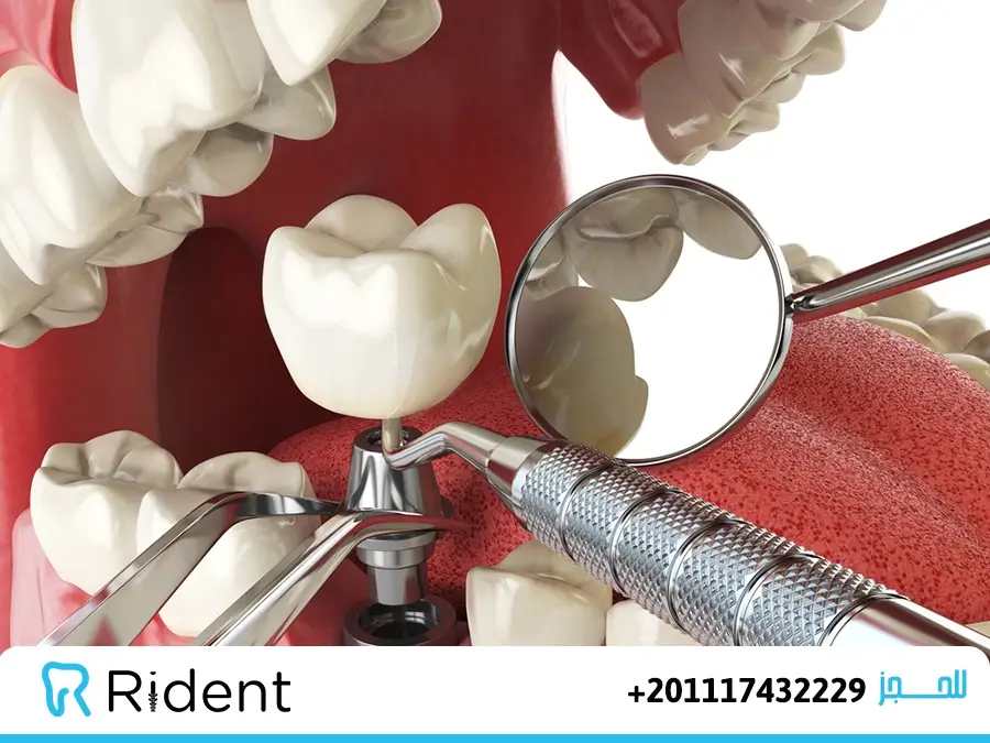 انواع زراعة الاسنان