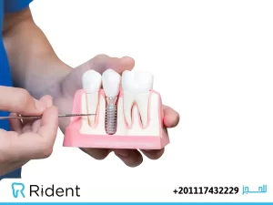 بدائل زراعة الأسنان