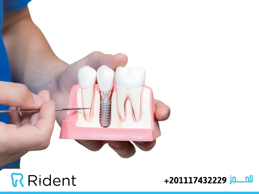 بدائل زراعة الأسنان