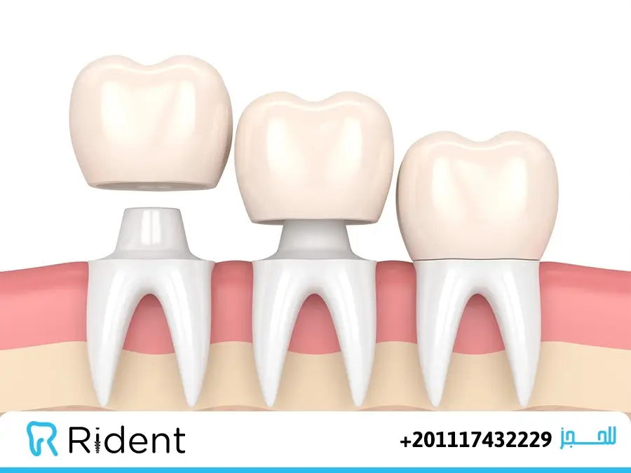 بدائل طربوش الأسنان