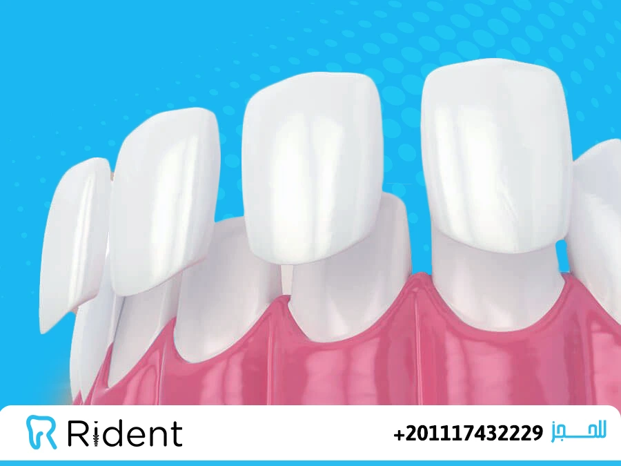 تأمين الاسنان 1 كيفية تأمين الاسنان
