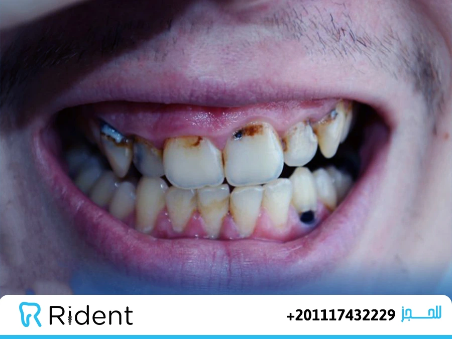 تاكل جذور الاسنان