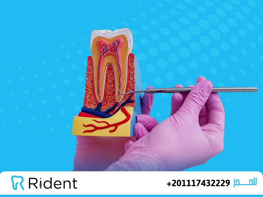 تاكل جذور الاسنان