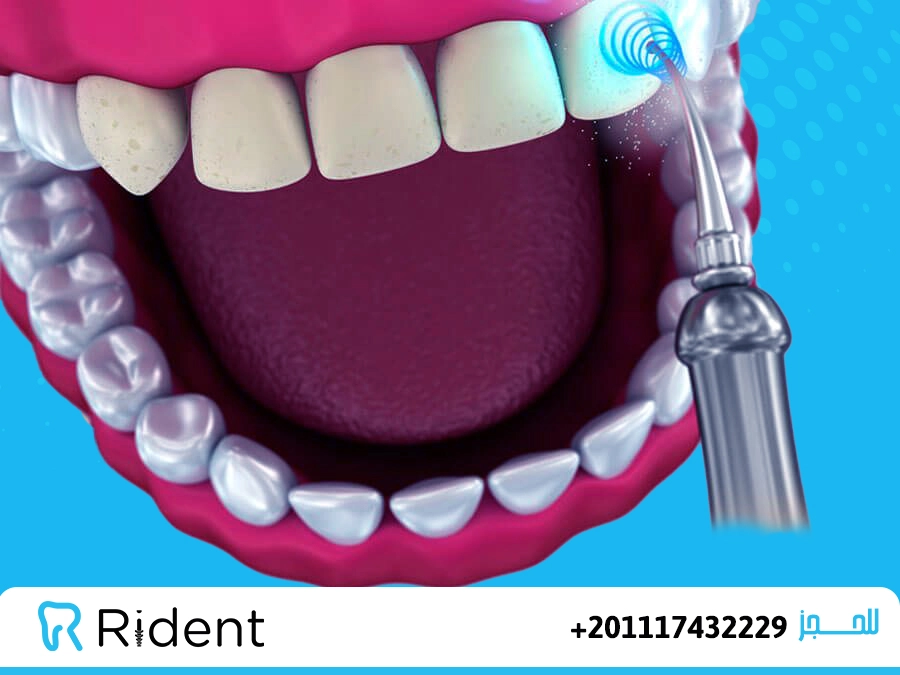 تبييض الاسنان بالليزر