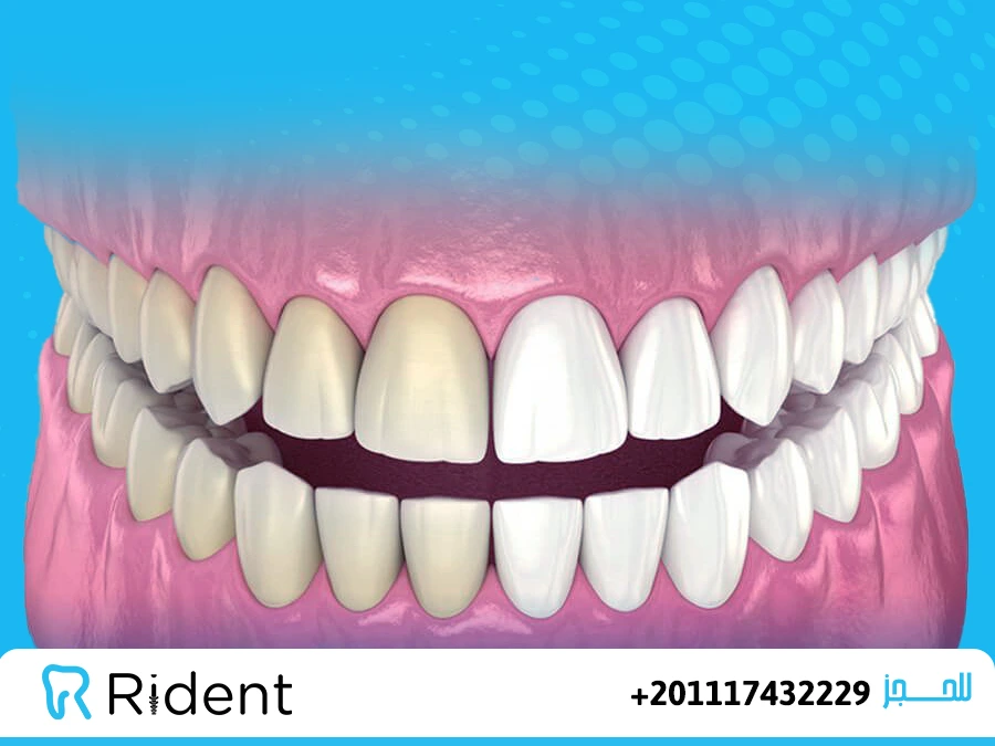 تبييض الاسنان بالليزر2