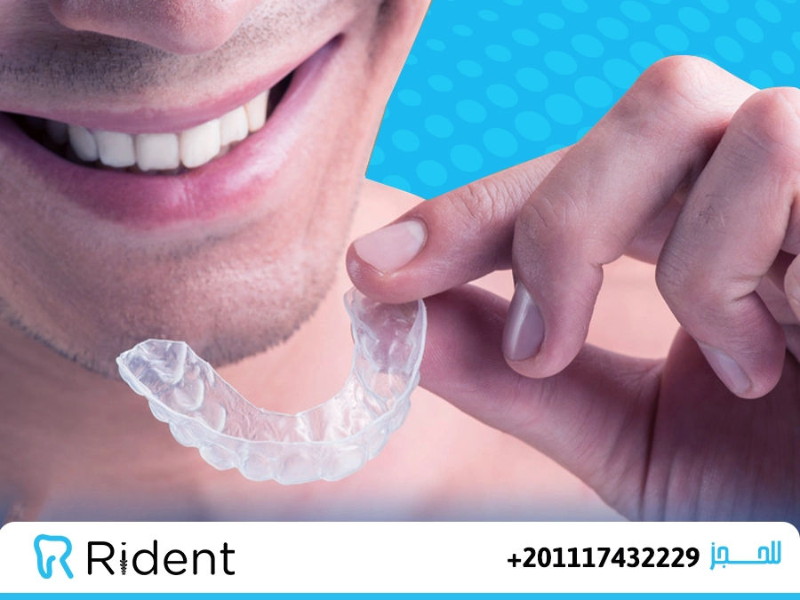 تجربتي مع التقويم الشفاف من البداية للنهاية 4 تجربتي مع التقويم الشفاف من البداية للنهاية