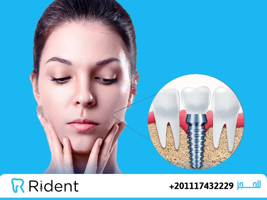 تجربتي مع زراعة الاسنان