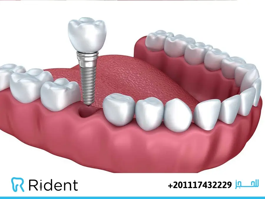 تركيب اسنان