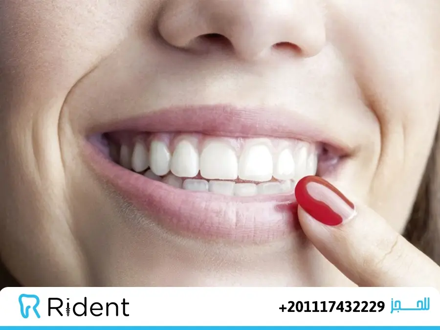 تركيب الأسنان الأمامية