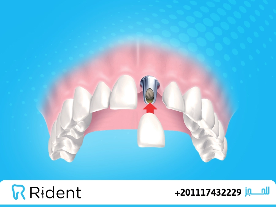 تركيب الأسنان الأمامية في 4 خطوات فقط 3 تركيب الزيركون للاسنان الامامية