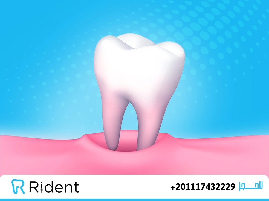 تركيب الضرس بعد الخلع