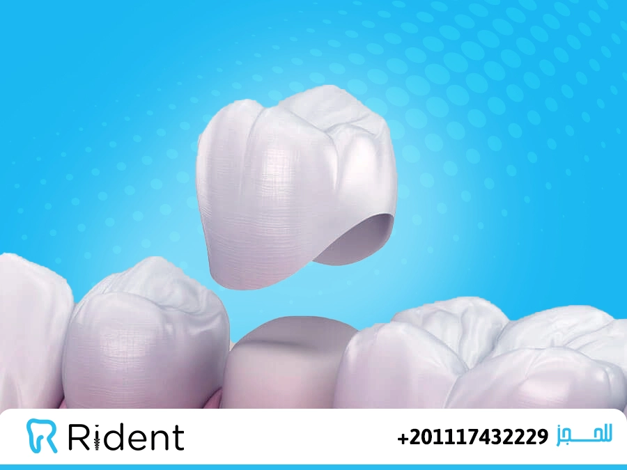 تركيب طربوش الاسنان