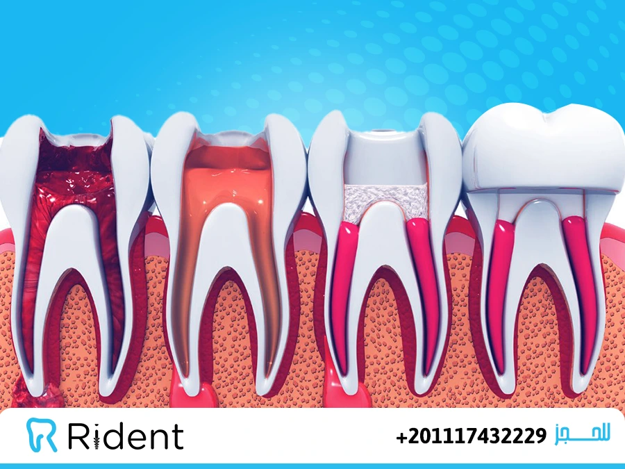 اسعار حشو الاسنان
