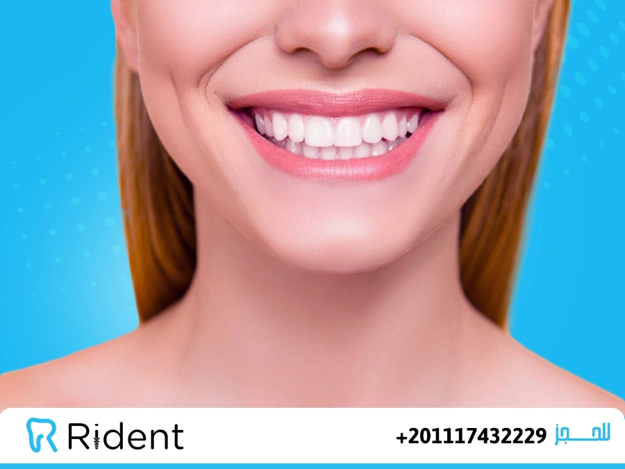 تكلفة ابتسامة هوليود