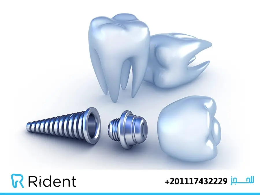 تكلفة زراعة الأسنان