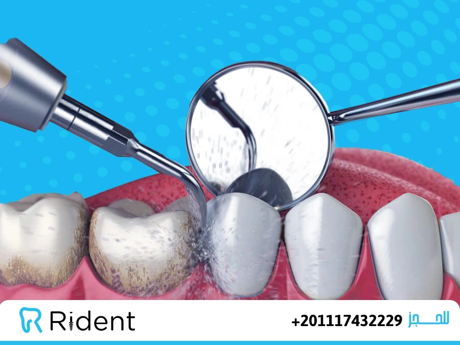 تنظيف الاسنان الصفراء 1 طرق تنظيف الاسنان الصفراء