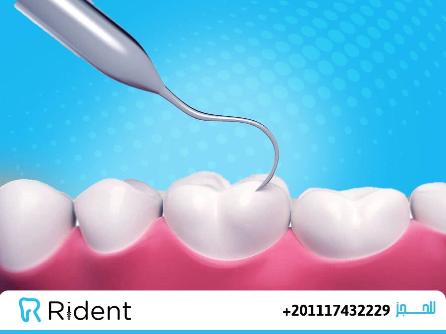 تنظيف الاسنان من الجير