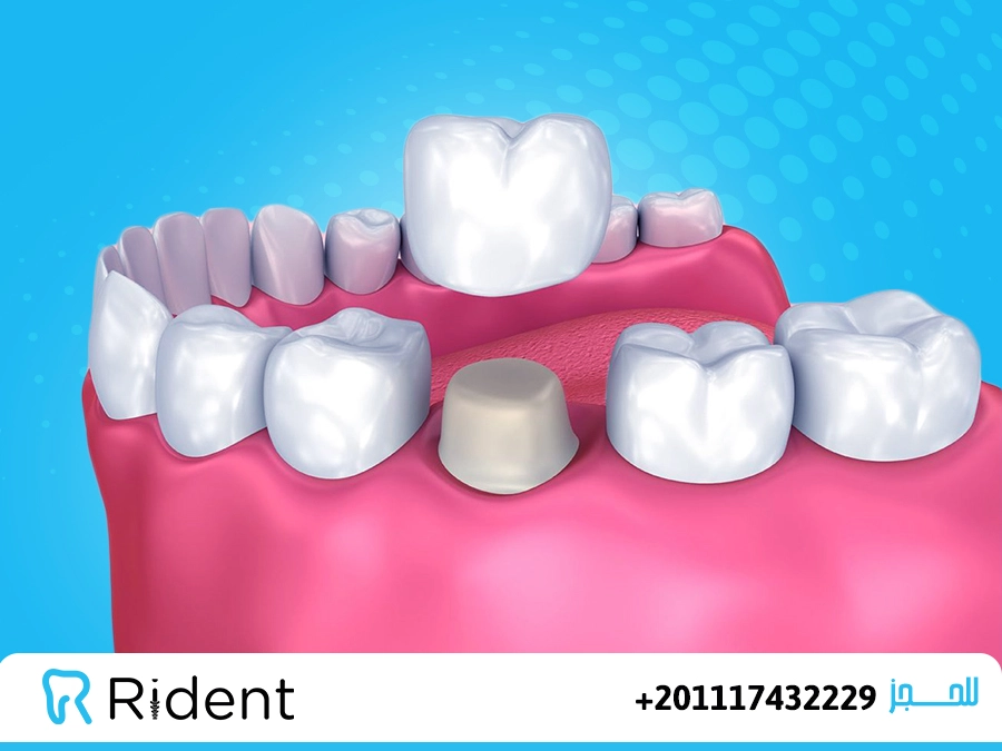 تيجان للاسنان