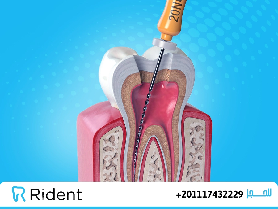 حشو الاسنان الامامية
