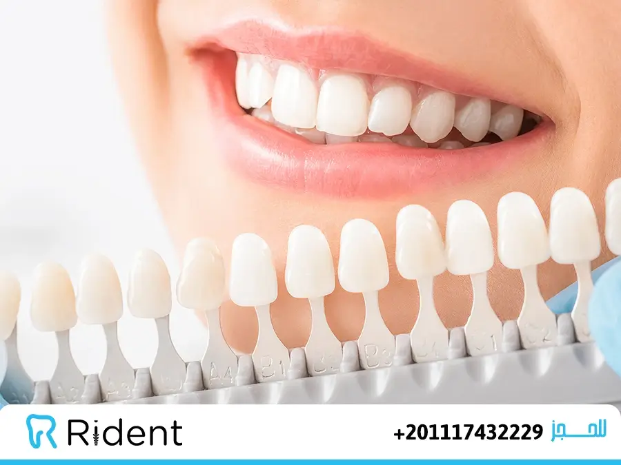 دايركت فينير