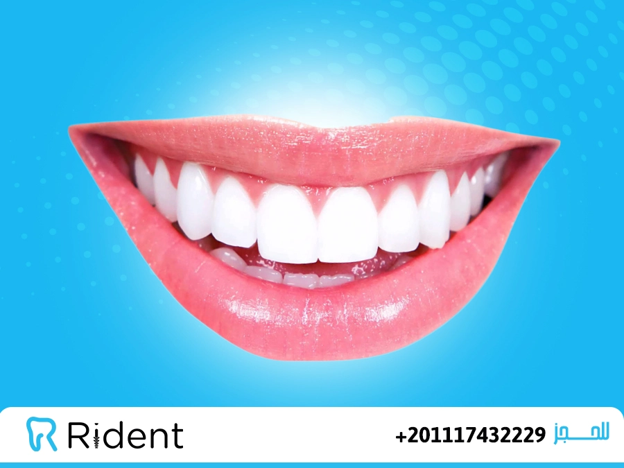 درجات تبييض الأسنان - دليلك لمعرفة درجات تبييض الأسنان 5 درجات تبييض الأسنان
