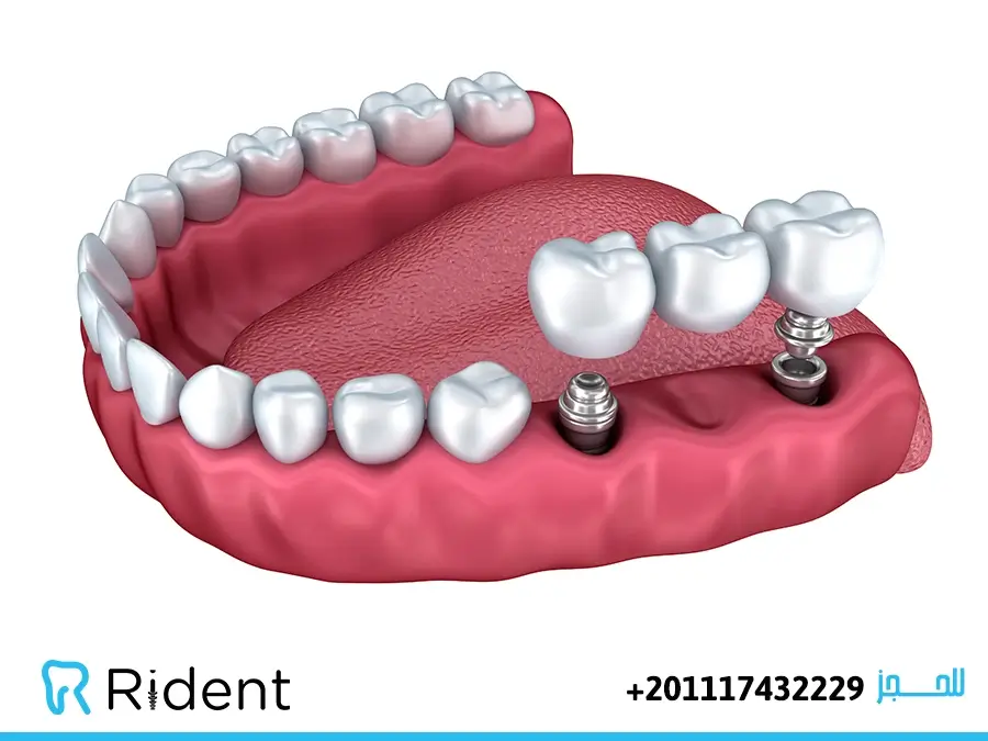 زراعة الأسنان (غرسات الأسنان) 3 زراعة الأسنان