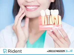 زراعة الأسنان