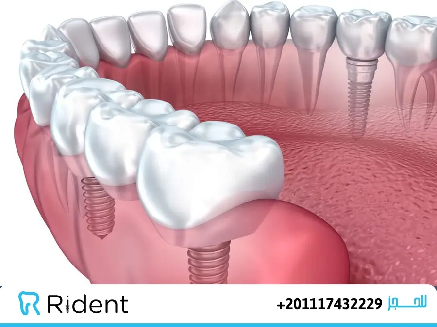 زراعة الضرس بكم