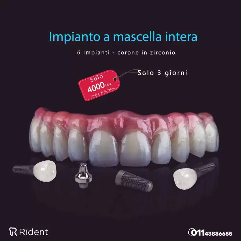 زراعة الفك بالكامل 1