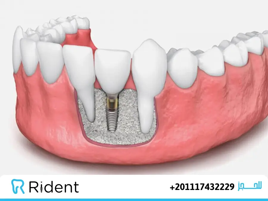 زراعة عظم الفك