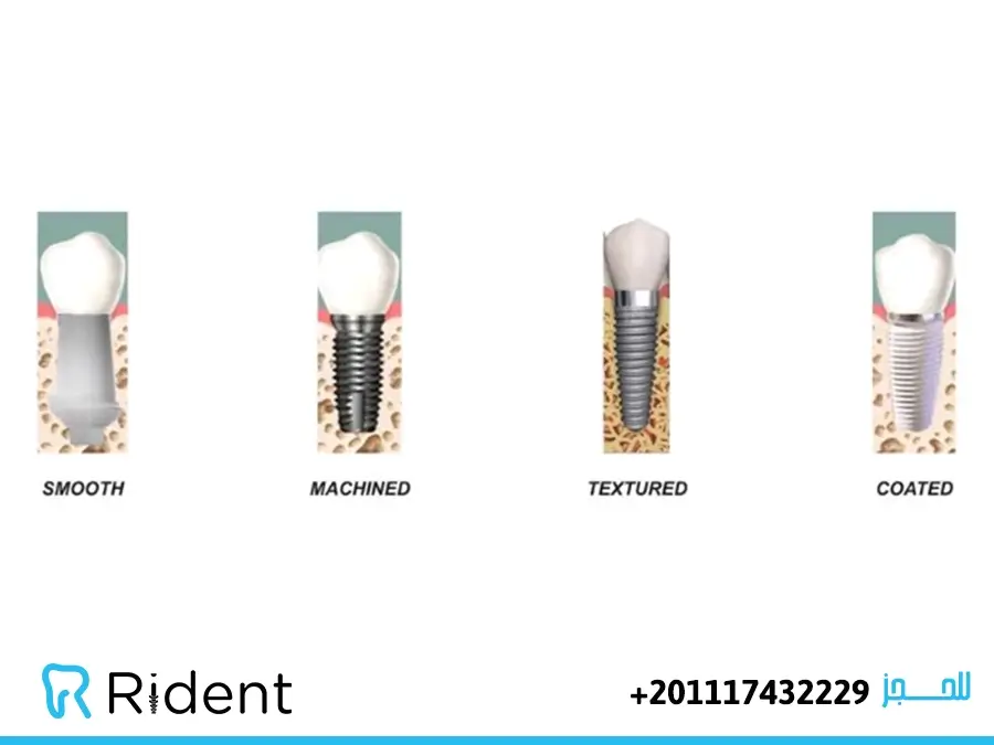 زرع الاسنان