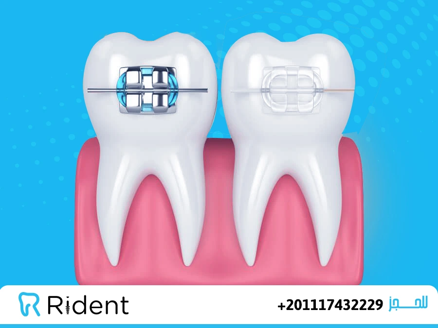 اسعار التقويم الشفاف 