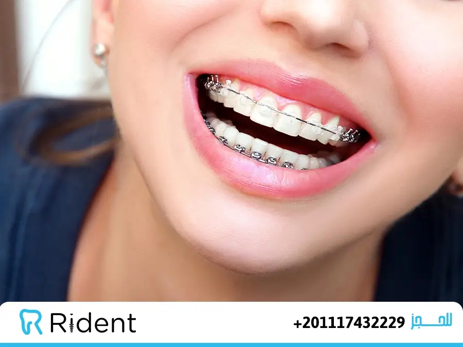 سعر تقويم الأسنان