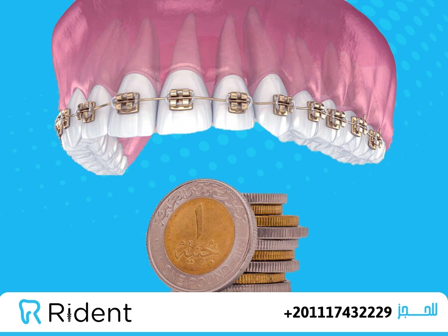 سعر تقويم الاسنان الفك العلوي فقط