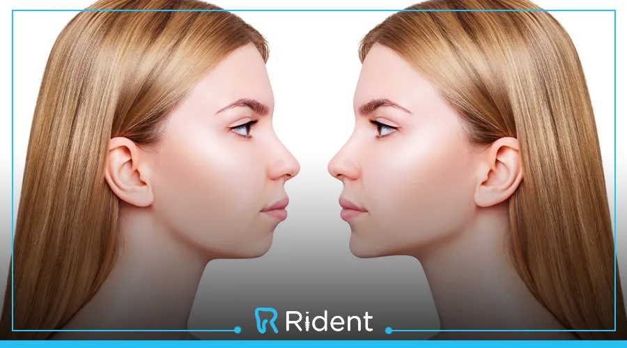 سعر عملية الفك العلوي 7 سعر عملية الفك العلوي