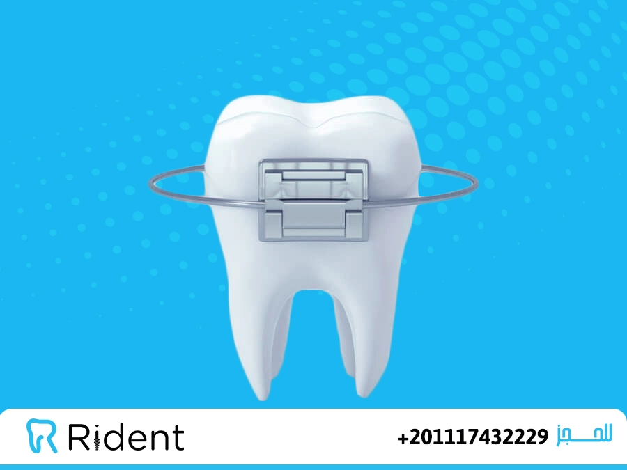 سعر مثبت الاسنان بعد التقويم