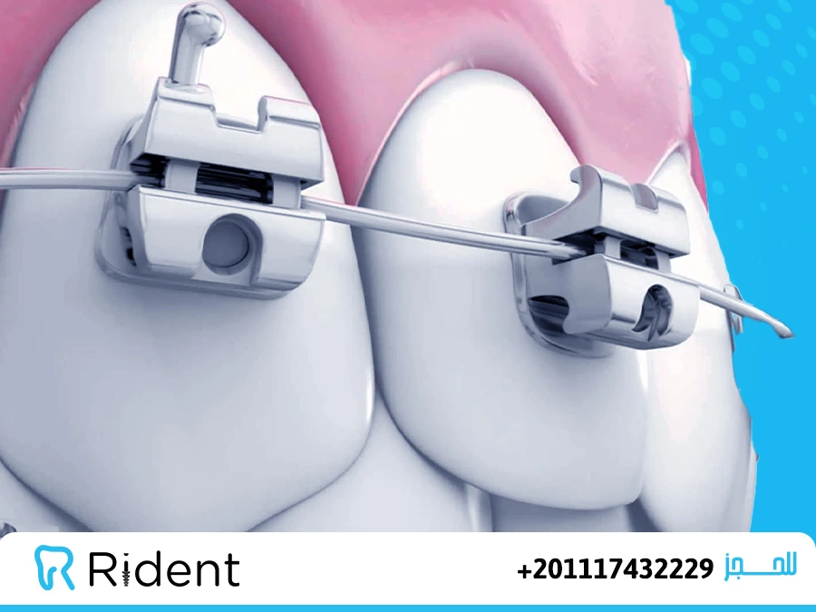 أسعار مثبت الاسنان بعد التقويم