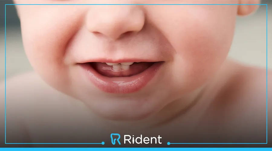 شكل لثة الرضيع عند التسنين بالصور 5 شكل لثة الرضيع عند التسنين