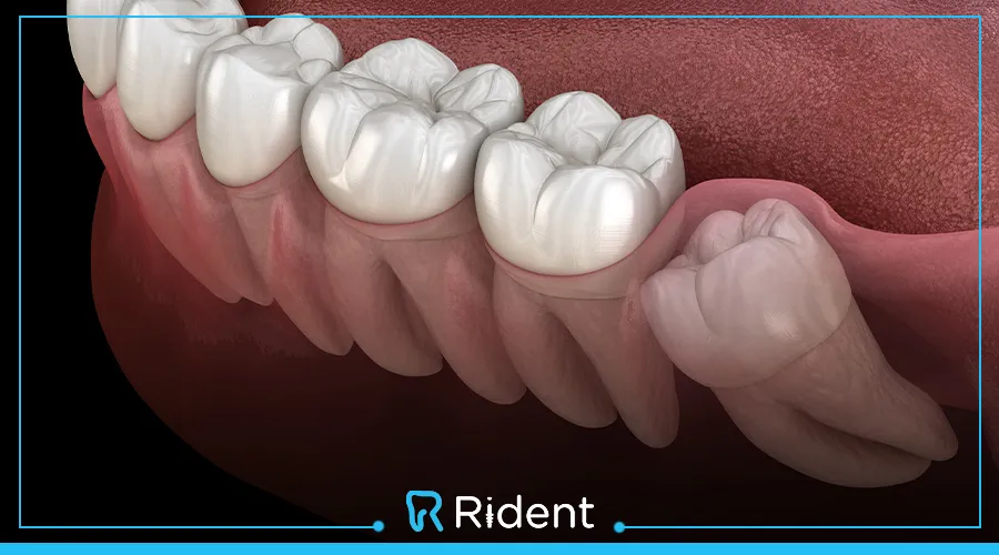 كل ما تحتاج معرفته عن ضرس العقل المدفون | الأعراض والعلاج 1 ضرس العقل المدفون