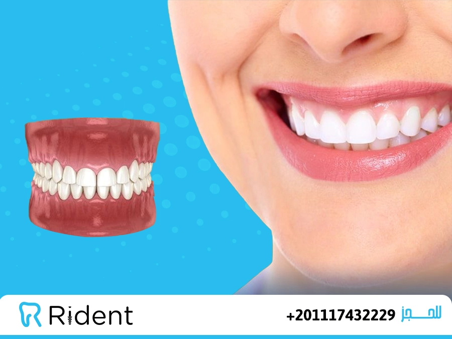 طرق علاج الابتسامة اللثوية