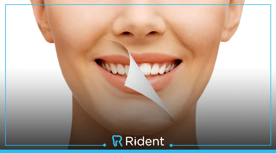 تبيض الاسنان في العيادة