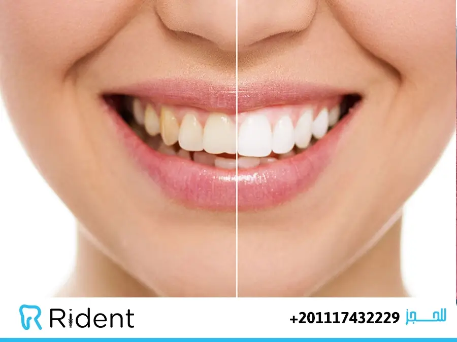 اصفرار الاسنان